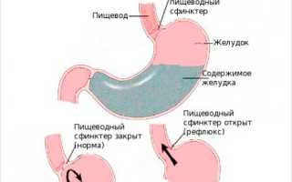 Дуоденогастральный рефлюкс: симптомы дгр, лечение