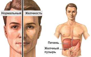 Что за болезнь Синдром Жильбера: диагностика, симптомы, лечение