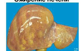 Печень в жиру: что это значит и как лечить?