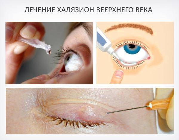 Лечение халязиона без операции