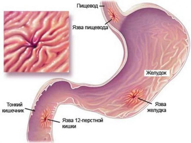Рецепты диетических блюд при гастрите и язве