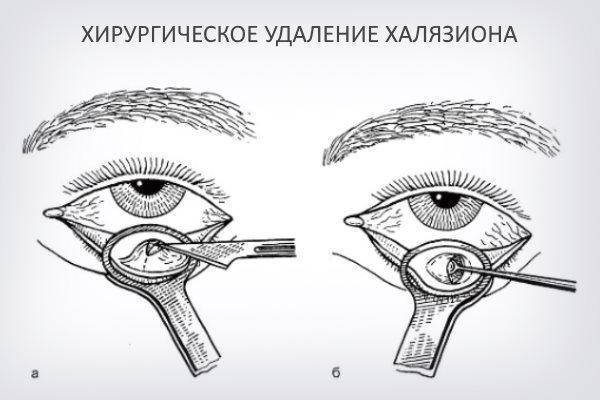Лечение халязиона без операции
