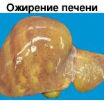 Печень в жиру: что это значит и как лечить?