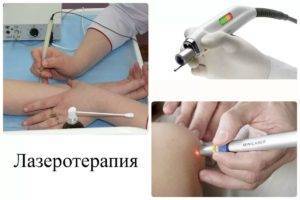 Папиллома на веке глаза: почему появляются и как удалить папилломы на верхнем и нижнем веке