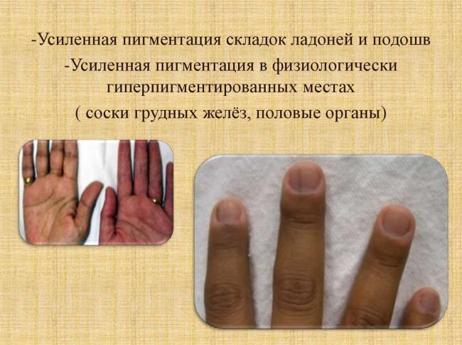 Болезнь аддисона
