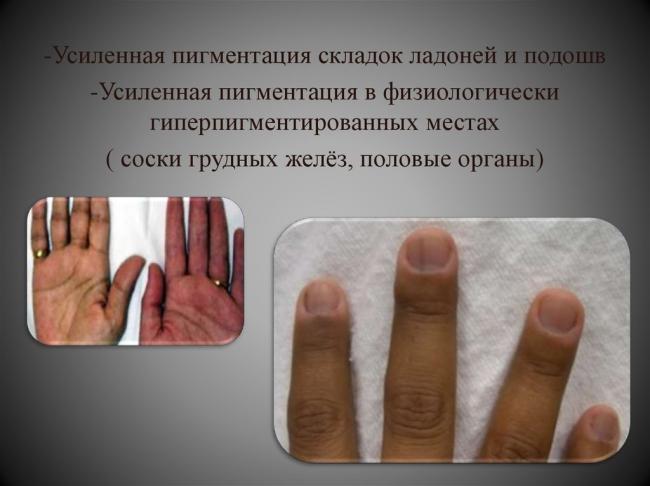 Болезнь аддисона симптомы у женщин. бронзовая болезнь, причины, симптомы, лечение