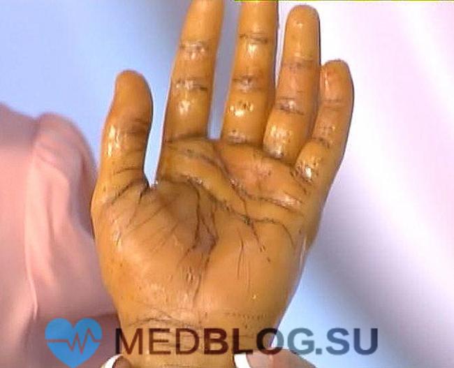 Чем опасна болезнь аддисона