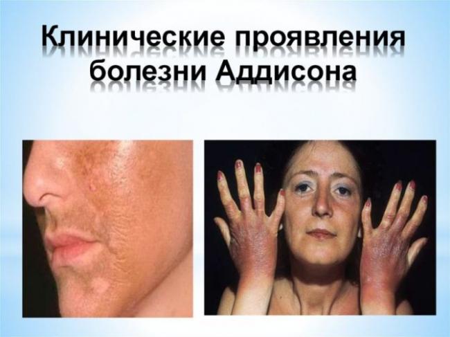 Болезнь аддисона – почему и как развивается гипокортицизм?