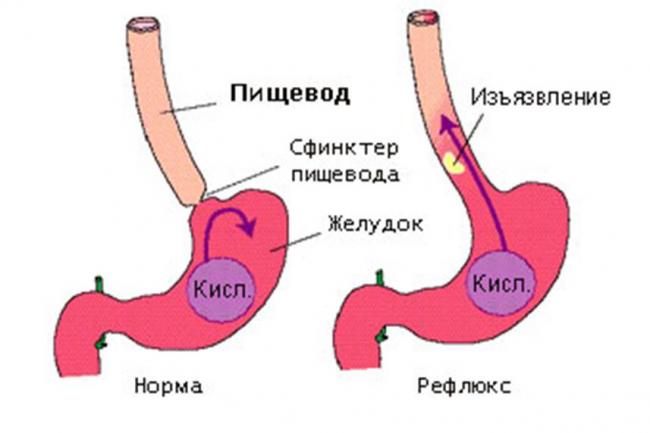 Дуодено гастральный рефлюкс что это такое?