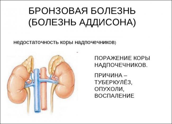 Болезнь аддисона