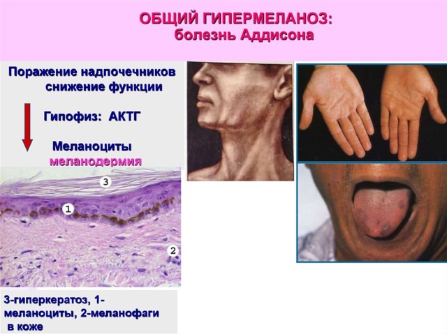 Болезнь аддисона