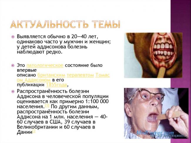 Болезнь аддисона