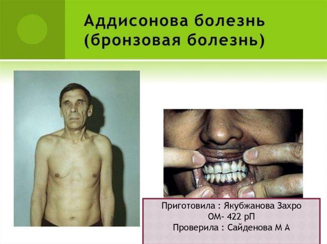 Что такое болезнь аддисона, как она проявляется и лечится?
