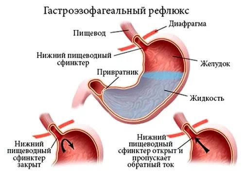 Дуодено-гастральный рефлюкс 1, 2, 3, 4 степени – причины, признаки, лечение, диета. как лечить дуодено-гастральный рефлюкс народными средствами?