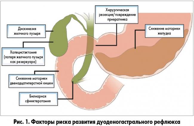 Дуодено-гастральный рефлюкс – ищем причины и выбираем лечение