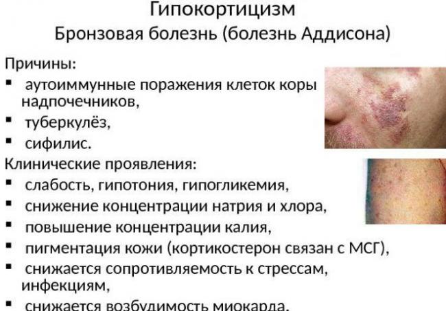 Болезнь аддисона — википедия с видео // wiki 2