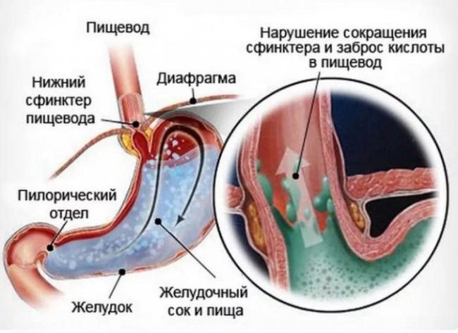 Дуодено-гастральный рефлюкс: что это такое, причины, симптомы, диагностика и лечение (диета, препараты, народные средства)