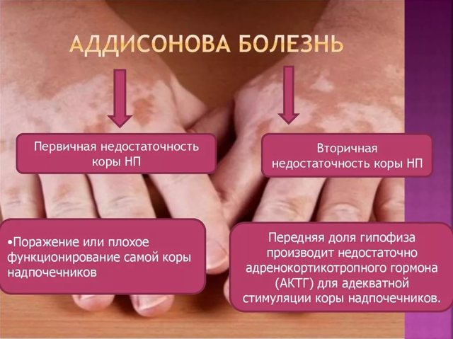 Болезнь аддисона бирмера у женщин и мужчин – симптомы, диагностика, причины и лечение заболевания - docdoc.ru