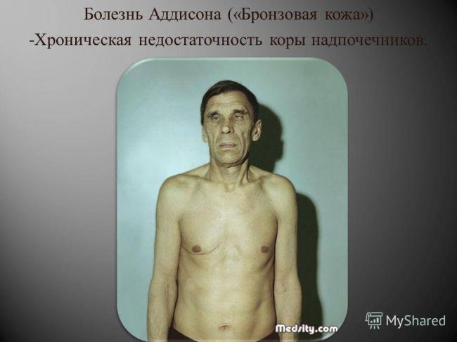 Болезнь аддисона — симптомы