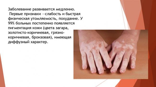 Болезнь аддисона симптомы у женщин. бронзовая болезнь, причины, симптомы, лечение
