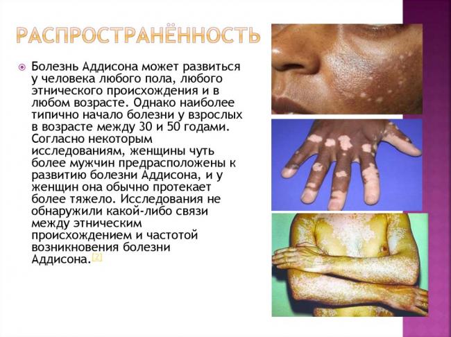 Болезнь аддисона: что это такое, симптомы и лечение, первые признаки