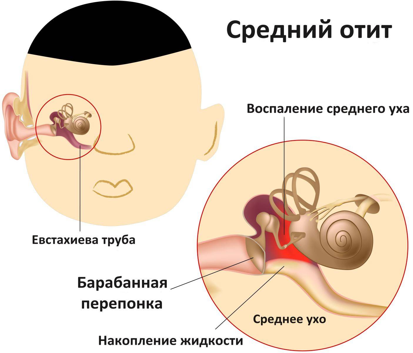 Если болит ухо у ребенка, что делать в домашних условиях: камфорное масло