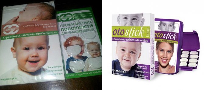 Лопоухость: причины, можно ли исправить без операции, коррекция