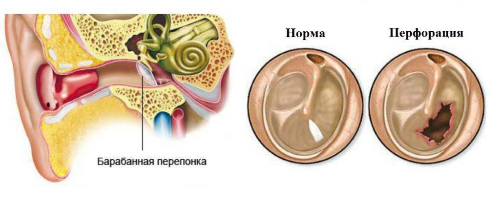 Камфорное масло в ухо при отите и боли