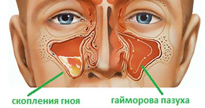 Можно ли греть нос при гайморите: методы прогревания, противопоказания и лечебный эффект