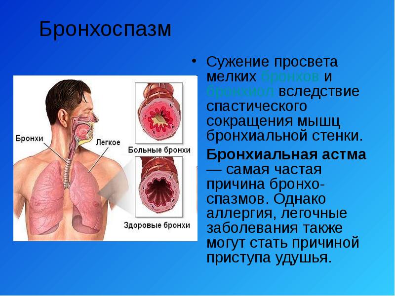 Как оказать неотложную помощь при приступе ларингоспазма: что делать в экстренном случае