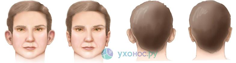 Лопоухость