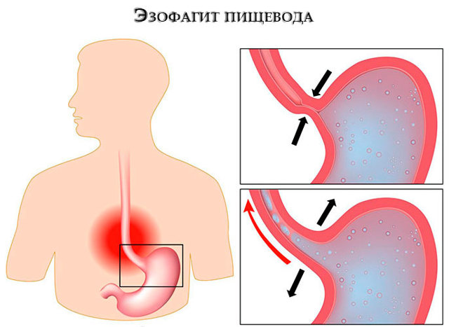Диета при гэрб с эзофагитом