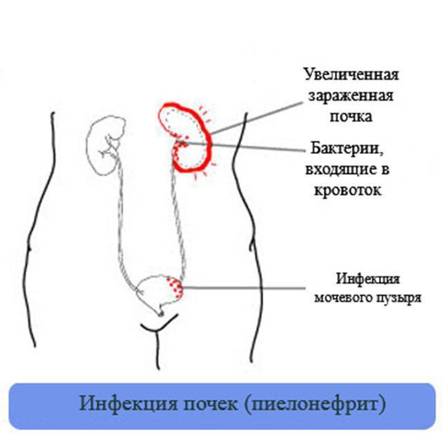 Обнаружено в моче большое количество бактерий: что это значит, чем лечить