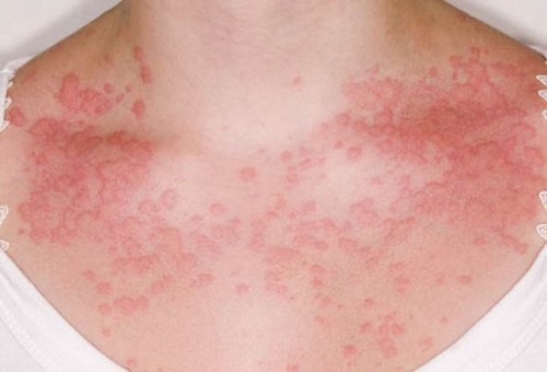 Локоид липокрем (locoid lipocrem)