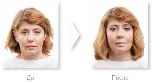 Симптомы болезни - потеря объема лица