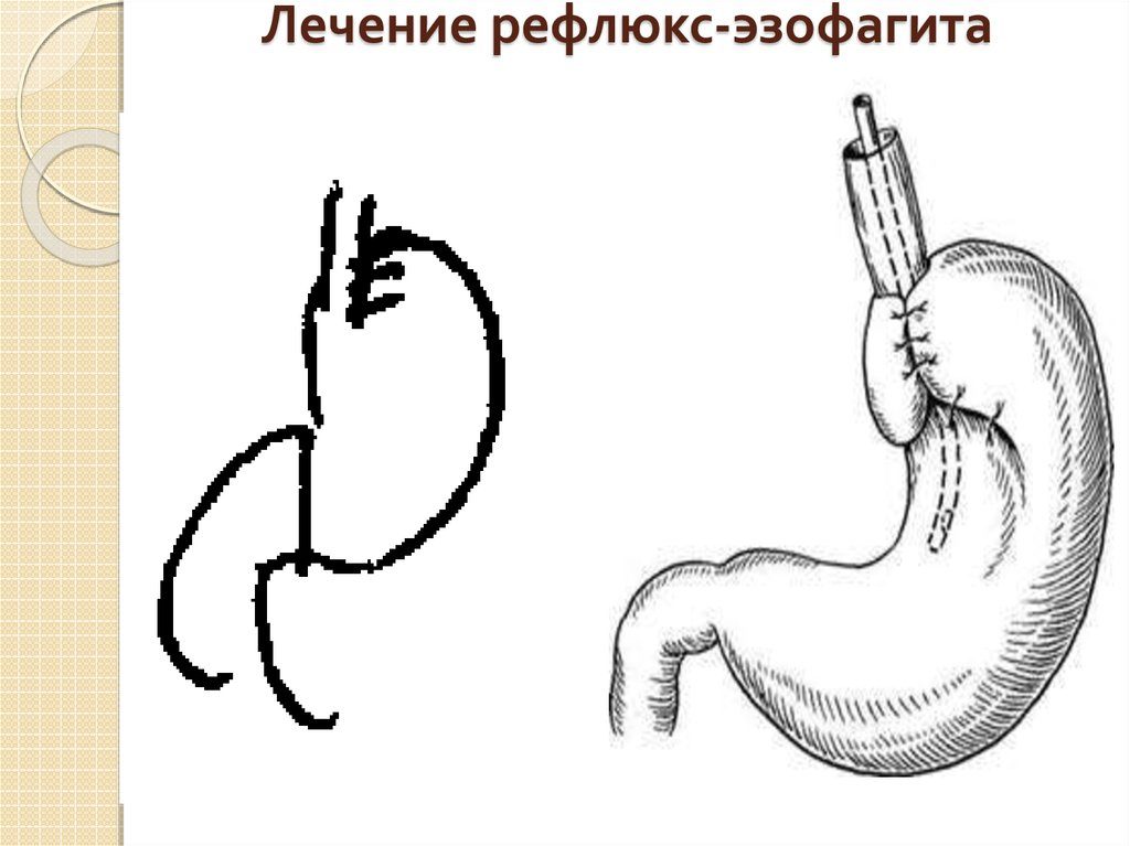 Питание при гэрб (рефлюкс эзофагите пищевода): меню на каждый день