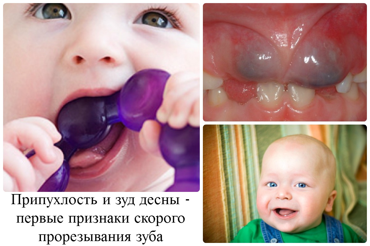 Все о прорезывании молочных зубов у младенцев...