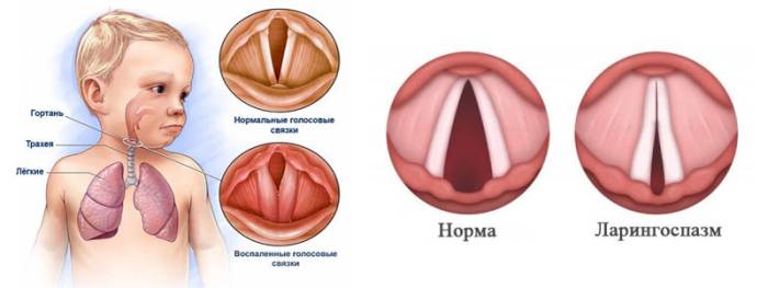 Первая неотложная помощь детям при ларингоспазме