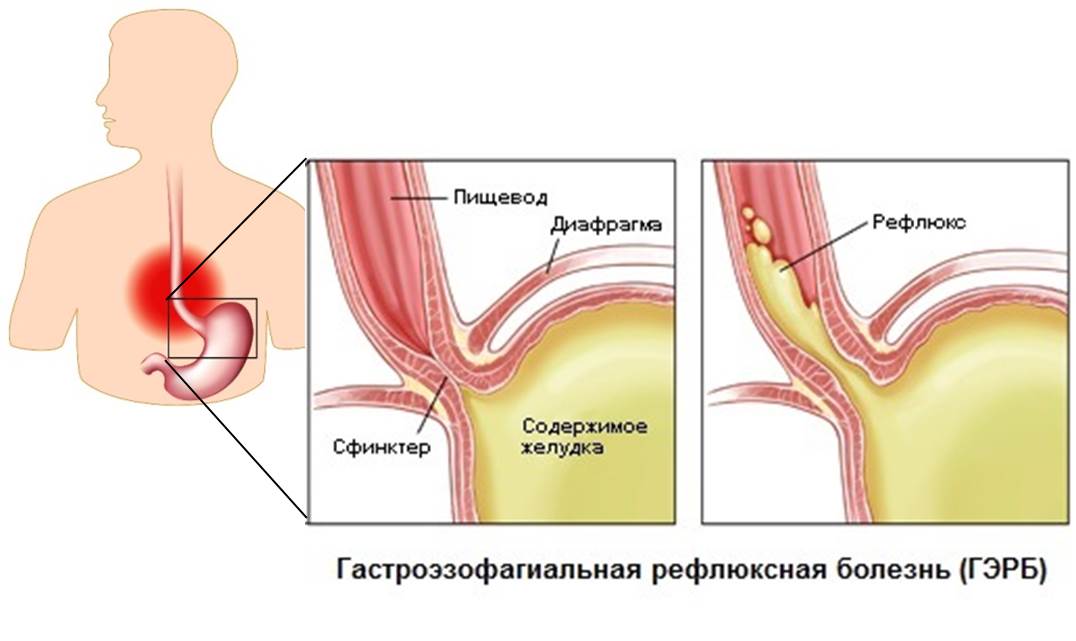 Диета при гастроэзофагеальной рефлюксной болезни