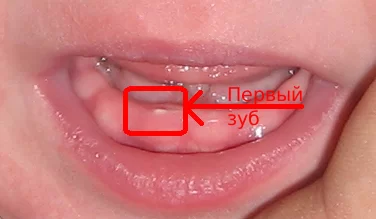 9 эффективных средств снять боль при прорезывании зубов у детей