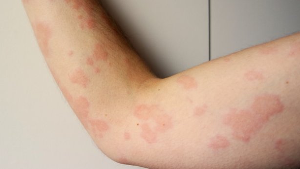 Локоид липокрем (locoid lipocrem)
