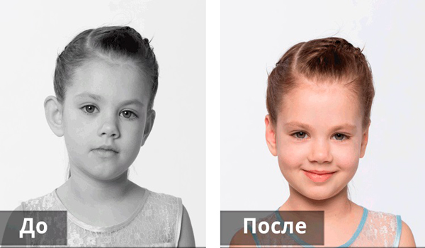 Коррекция ушей без операции