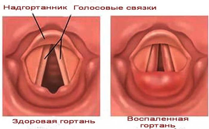 Первая помощь при приступе ларингоспазма у детей